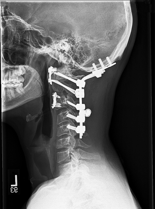 Lateral x-ray post-surgery for patient with en bloc chordoma spondylectomy